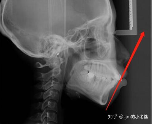 桂林正畸女大学生不励志辛酸史