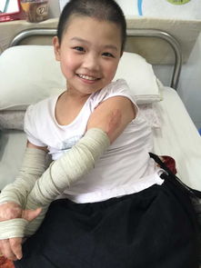 王梓瑜全身多处疤痕挛缩女孩梓瑜盼能站立走路急需8万